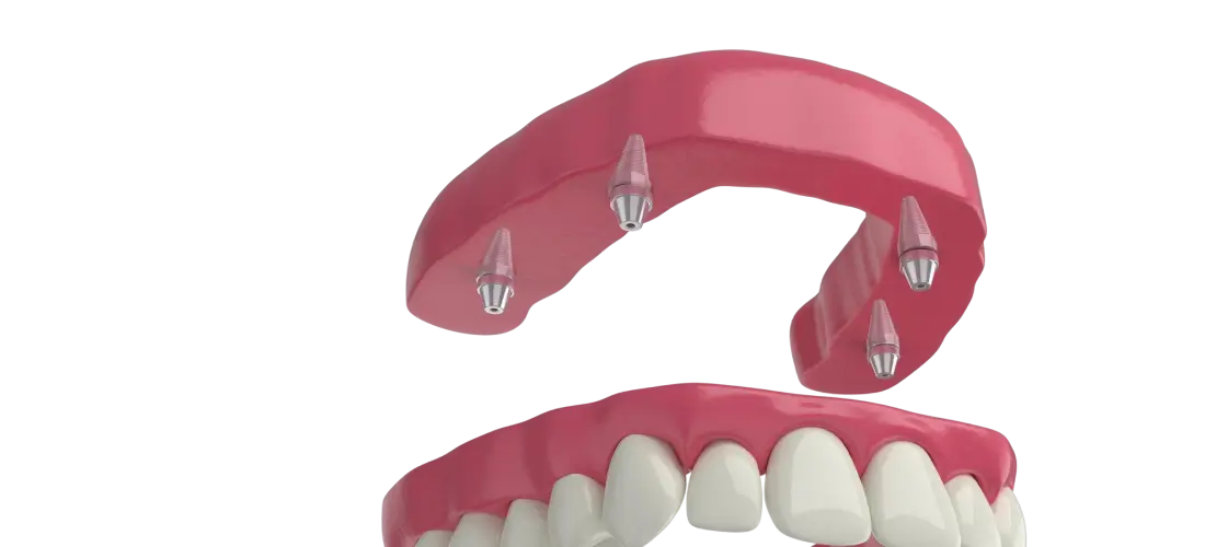 All-on-four concept Banner