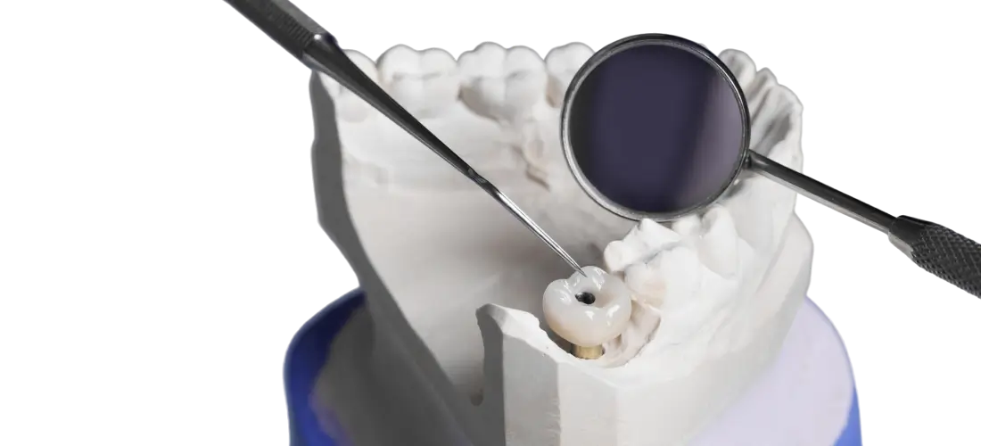 Bone Grafting Banner