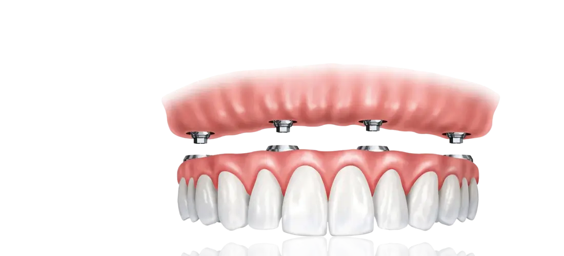 Full Mouth Rehabilitation-Banner