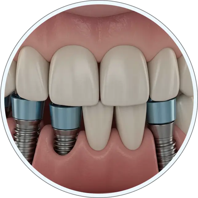 Multiple teeth dental-implants mobile