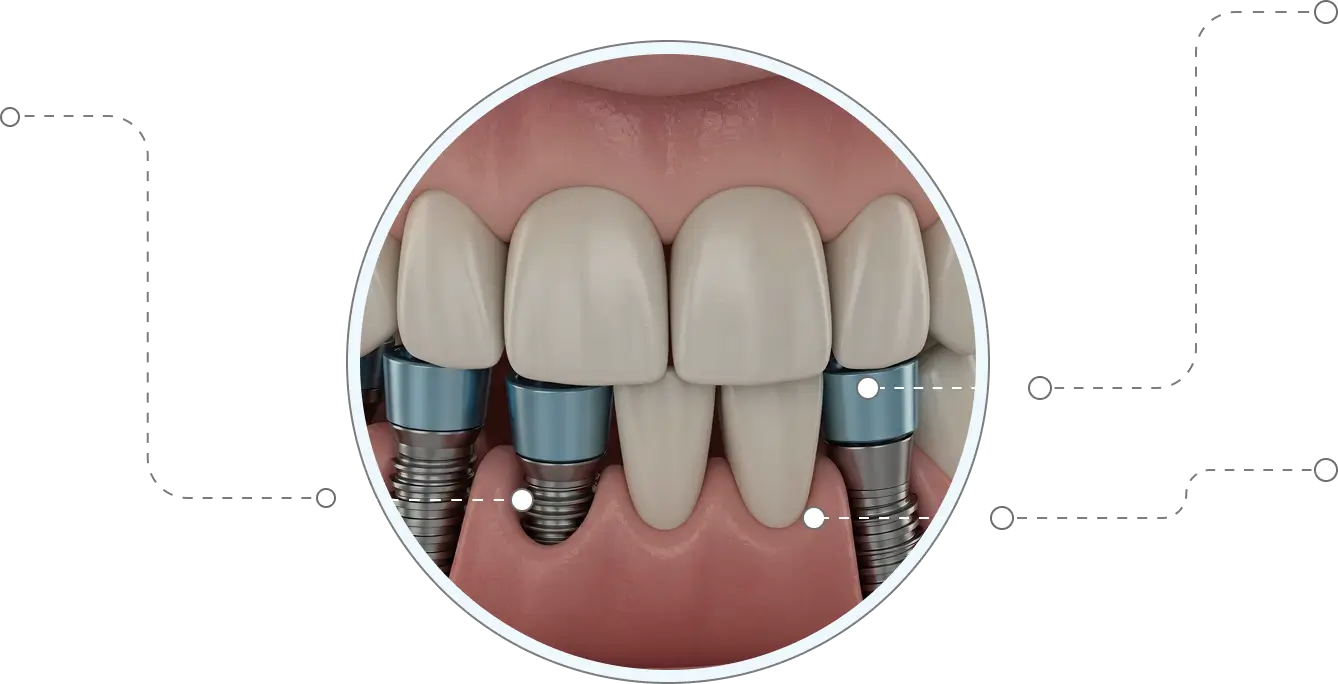 Multiple teeth dental implants