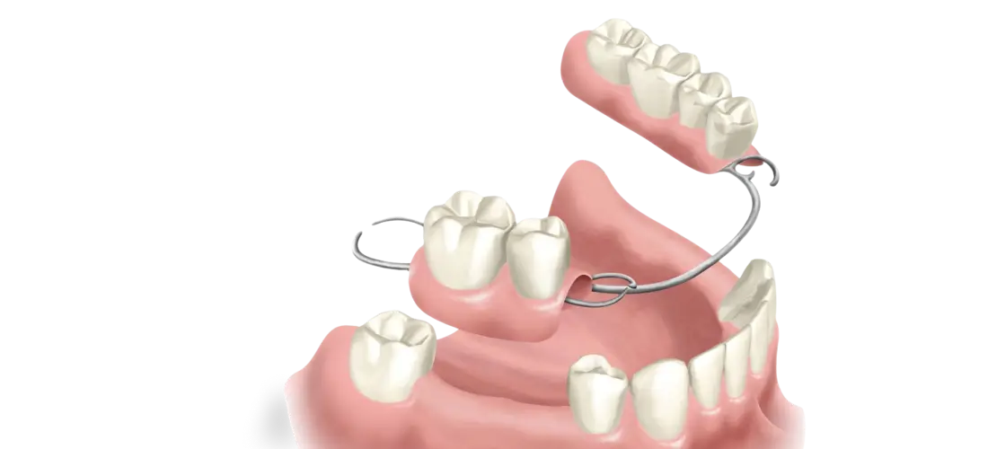 Multiple tooth Replacement Banner