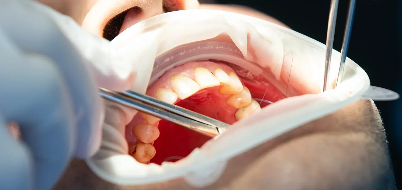 Periodontics Dentistry