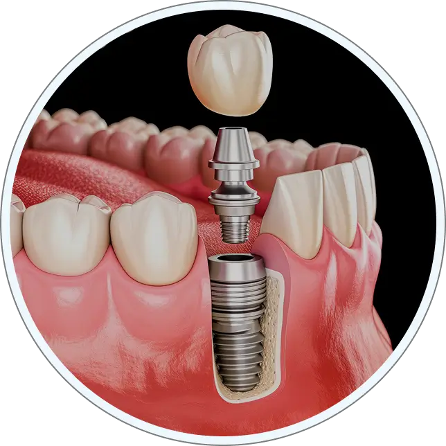 Single tooth implants mobile