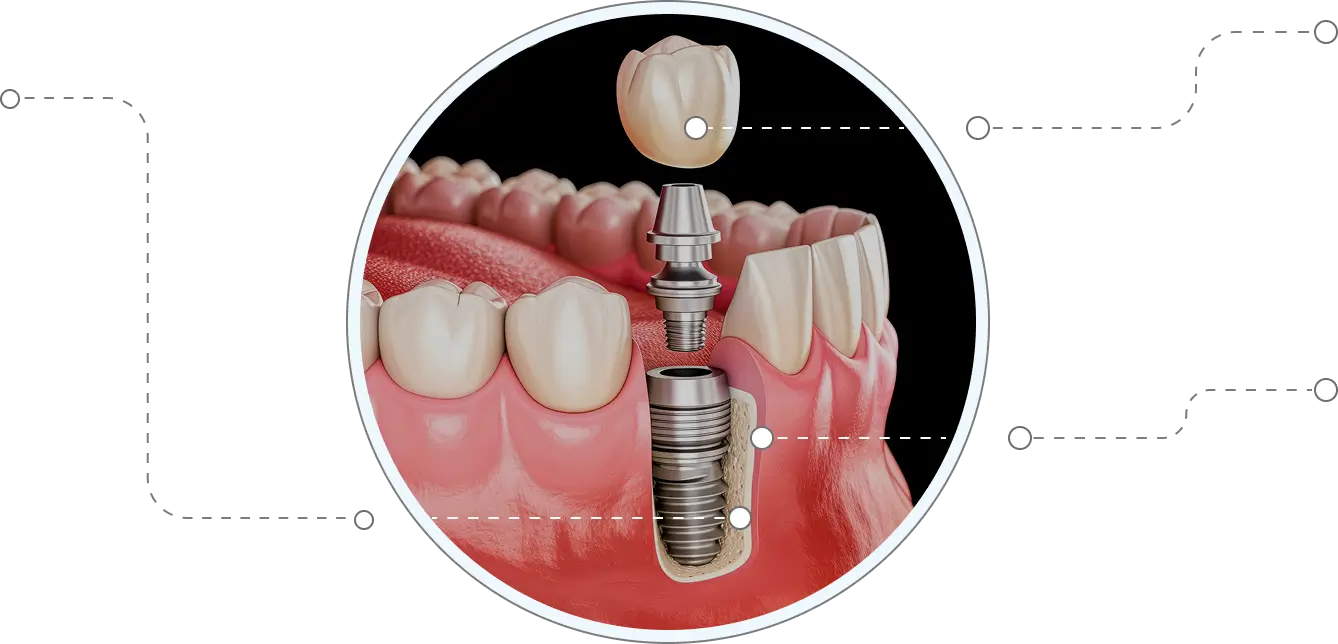 Single tooth implants